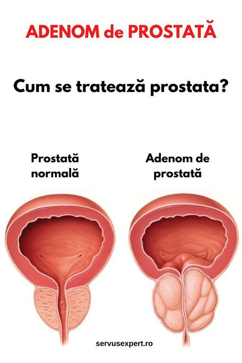 adenom de prostată cu malignitate. indiferent dacă trebuie tratat